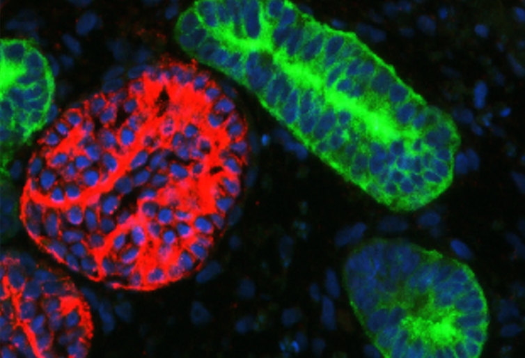 融合纳米药物与肾脏类器官：肾脏疾病研究的新范式与转化前沿